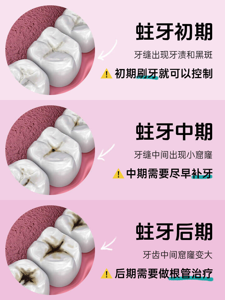 蛀牙怎么处理在疫情地区/已经蛀牙了怎么保护-第2张图片