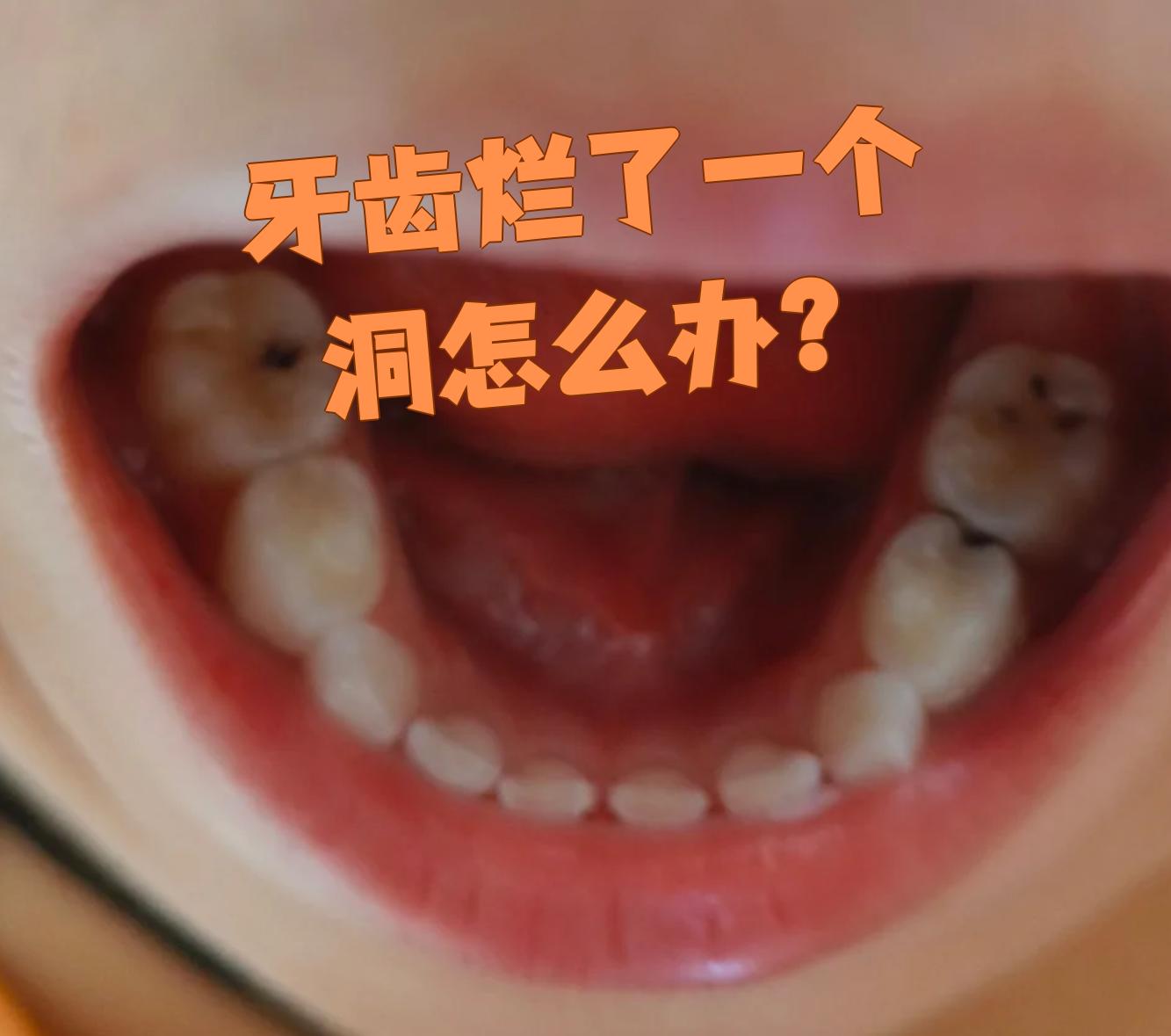 蛀牙怎么处理在疫情地区/已经蛀牙了怎么保护-第1张图片