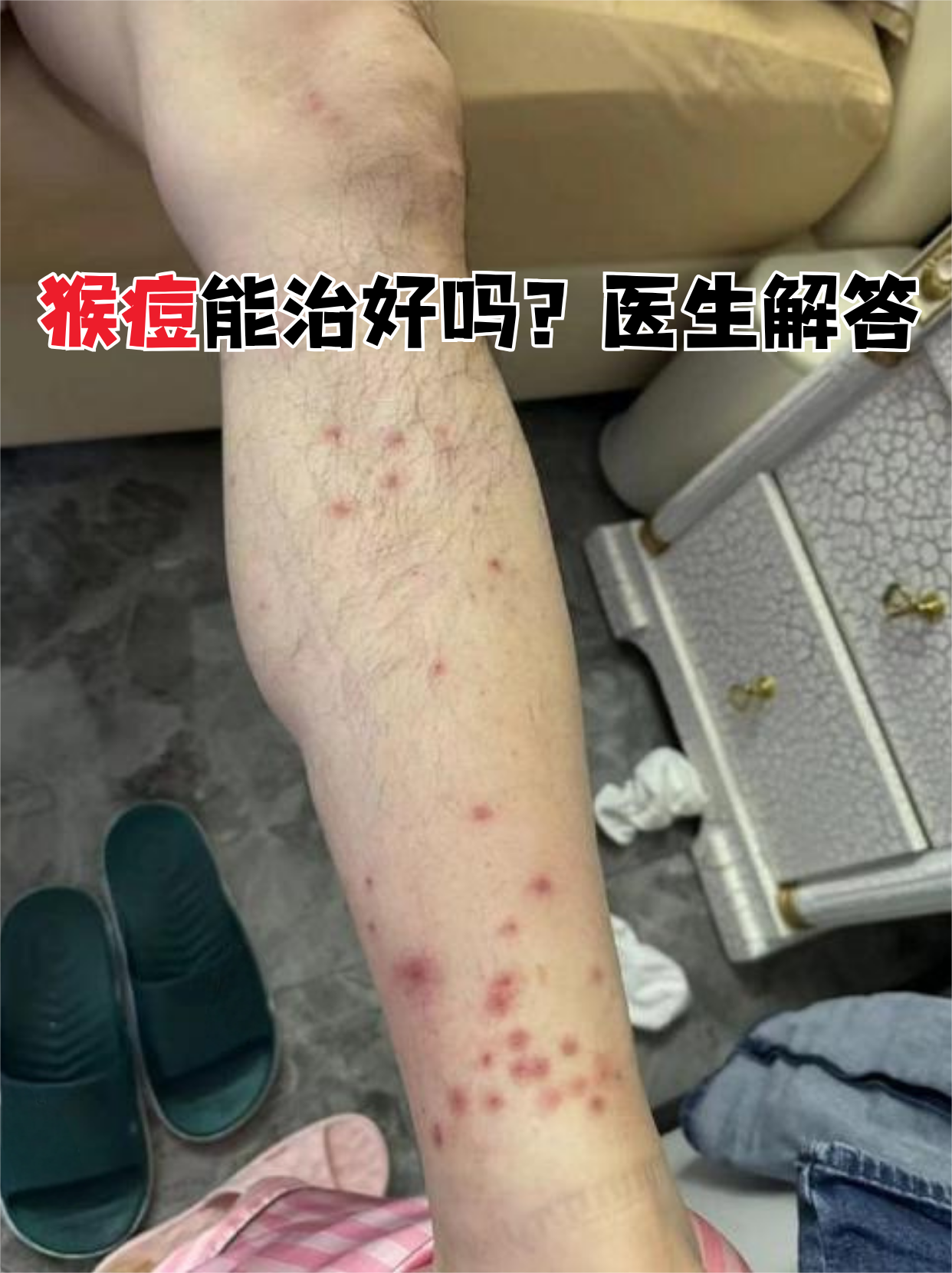 猴痘疫情中国哪些地区/猴痘症状-第3张图片
